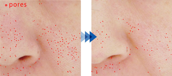 Blackheads ・Dull skin