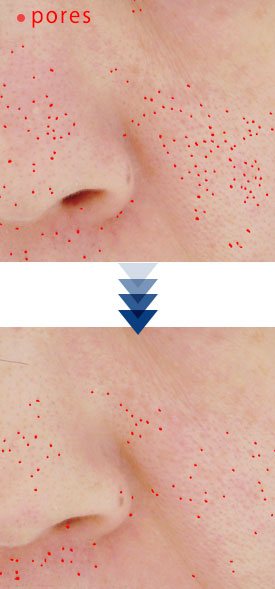 Blackheads ・Dull skin